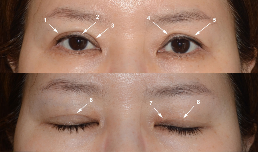 eye fold surgery