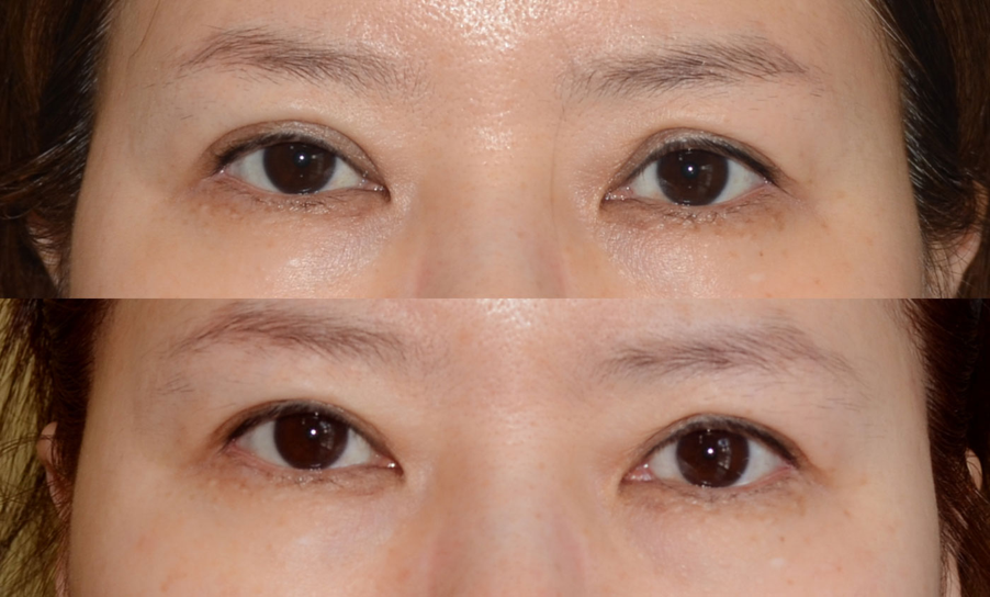 double crease eyelid